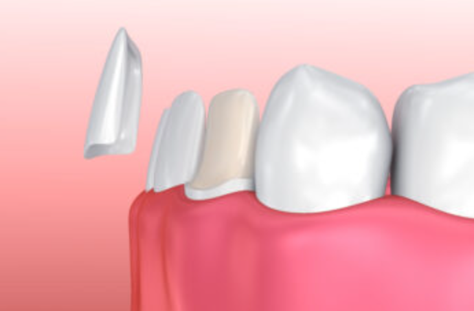 operazioni di estetica dentale a bergamo